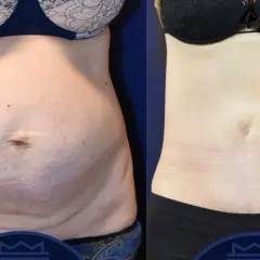 Före- och efterbilder visar tydliga fettsugning resultat på magen. Huden är slätare och midjan smalare.