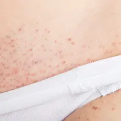 Närbild på hud med många små röda prickar och finnar på halsen, troligen efter rakning eller vaxning.
