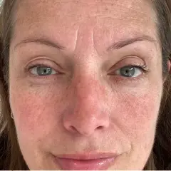 Närbild på en kvinna med grågröna ögon och mörkt hår. Hon har synliga linjer i pannan och pigmentfläckar i ansiktet, vilket kan vara ett tecken på att hon vill ta bort melasma.