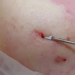 Närbild på hud där en subcision behandling utförs med ett vasst instrument som skär under ärr.