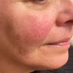 Närbild på en kvinnas kind med synliga röda blodkärl, ett tecken på rosacea. Behandling med IPL kan hjälpa.