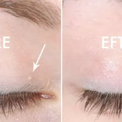 Före och efter: en vit prick i ansiktet, nära ögat, har behandlats.