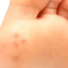 Närbild på en fot med flera vårtor, små vårtor med synliga svarta prickar inuti.