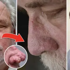 Före- och efterbilder som visar en mans näsa med rhinophyma och en läkare. Möjlig rhinophyma behandling.