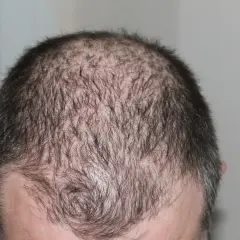 Huvud med tunt hår, visar fläckar av håravfall. Möjlig indikation på alopecia areata behandling.
