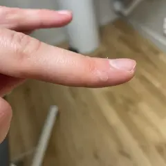 Närbild på en finger med en liten vårta på handflatan. Vårtan har en ringformad struktur.