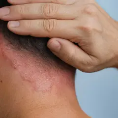 Nära bild på en person som kliar sig i hårbotten där det syns röda, fjällande utslag som kan vara svamp eller psoriasis.