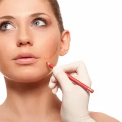 En hand i handske markerar ansiktet med en röd penna, förberedelse för buccal fat removal.