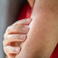 Nära bild på en arm med små knottror som tyder på keratosis pilaris. En hand rör vid huden.