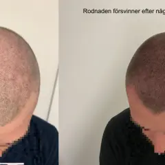 Före och efter bild på en hårtransplantation. Rodnaden i hårbotten, som kan uppstå efter att man vill exfoliera hårbotten, försvinner efter några timmar.