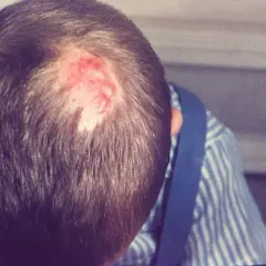 Röd, irriterad fläck på en persons huvud, där håret är tunt. Det ser ut som svamp i hårbotten.