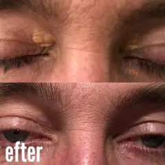 Före- och efterbilder som visar hur xantelasma har behandlats.