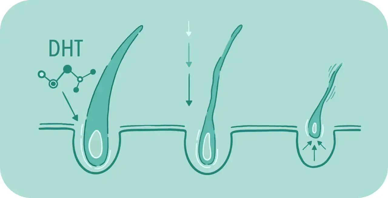 Illustration visar hur DHT påverkar hårsäckar, vilket leder till tunnare hår. Detta kan vara en orsak till håravfall hos dht kvinnor.