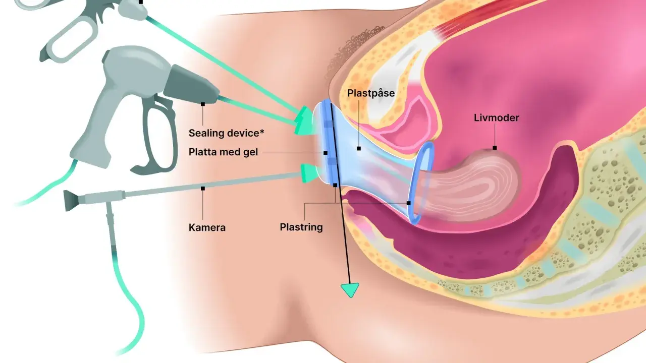 Illustration visar en medicinsk procedur för vaginal åtstramning med en kamera och en plastpåse som används för att dra åt.