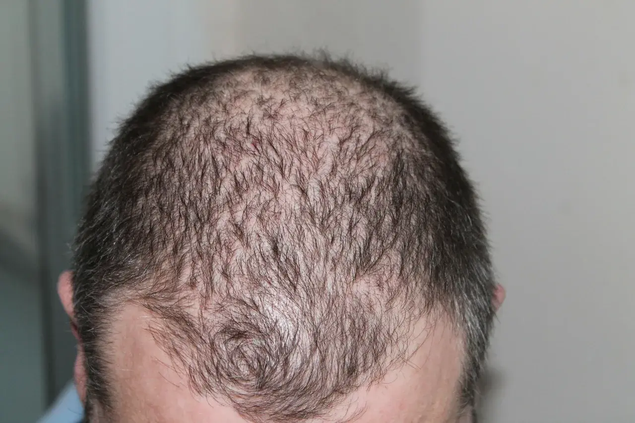 Huvud med tunt hår, visar fläckar av håravfall. Möjlig indikation på alopecia areata behandling.