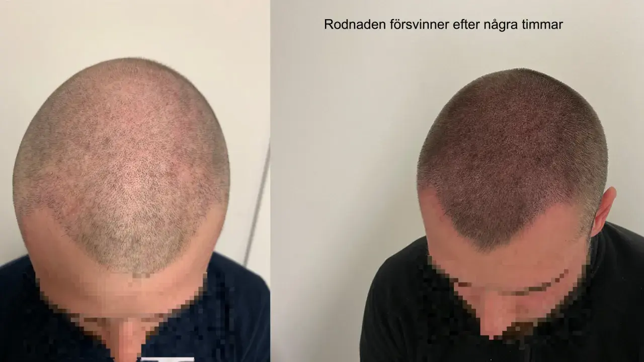 Före och efter bild på en hårtransplantation. Rodnaden i hårbotten, som kan uppstå efter att man vill exfoliera hårbotten, försvinner efter några timmar.