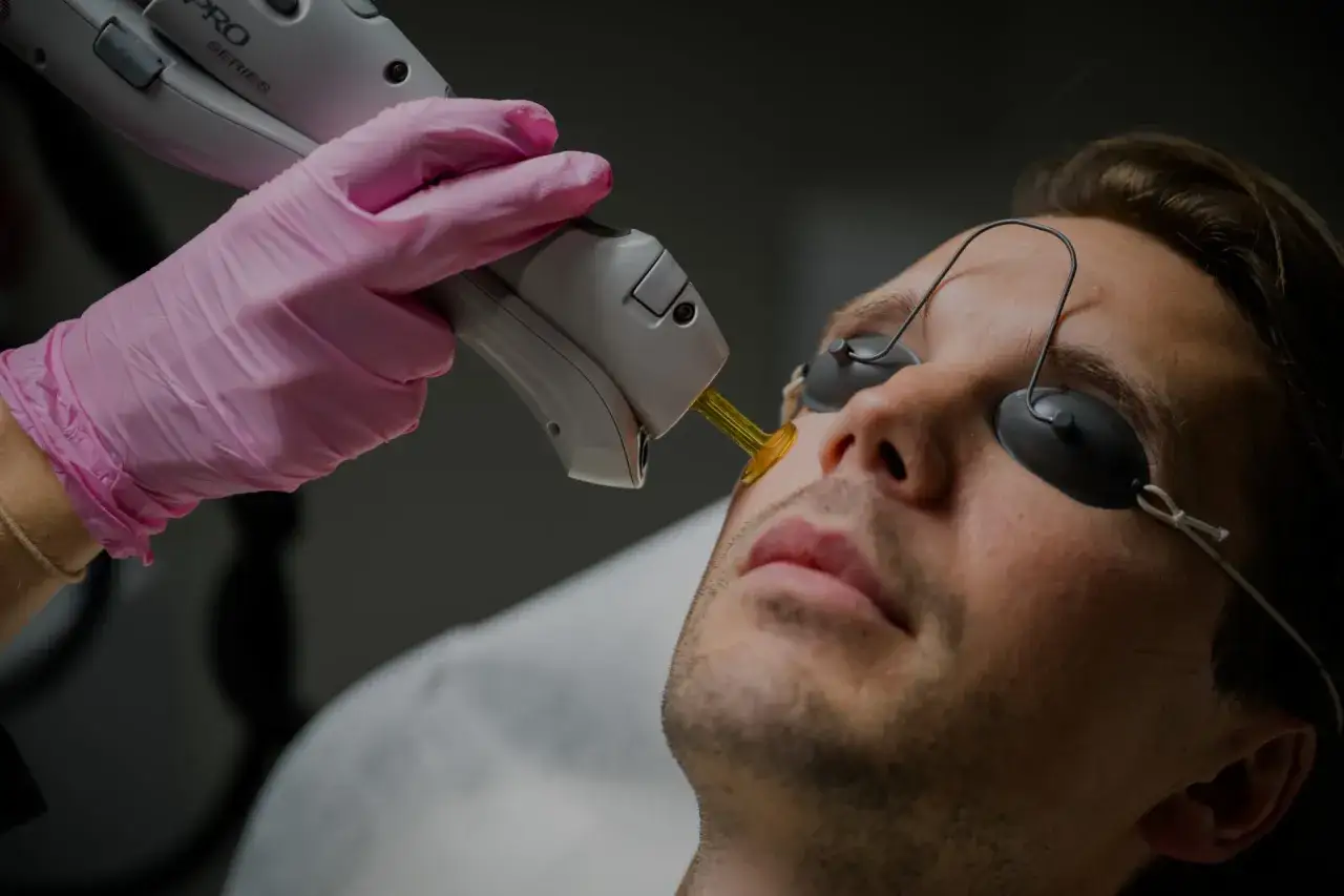 En person får laserbehandling för att ta bort hår i ansiktet permanent.