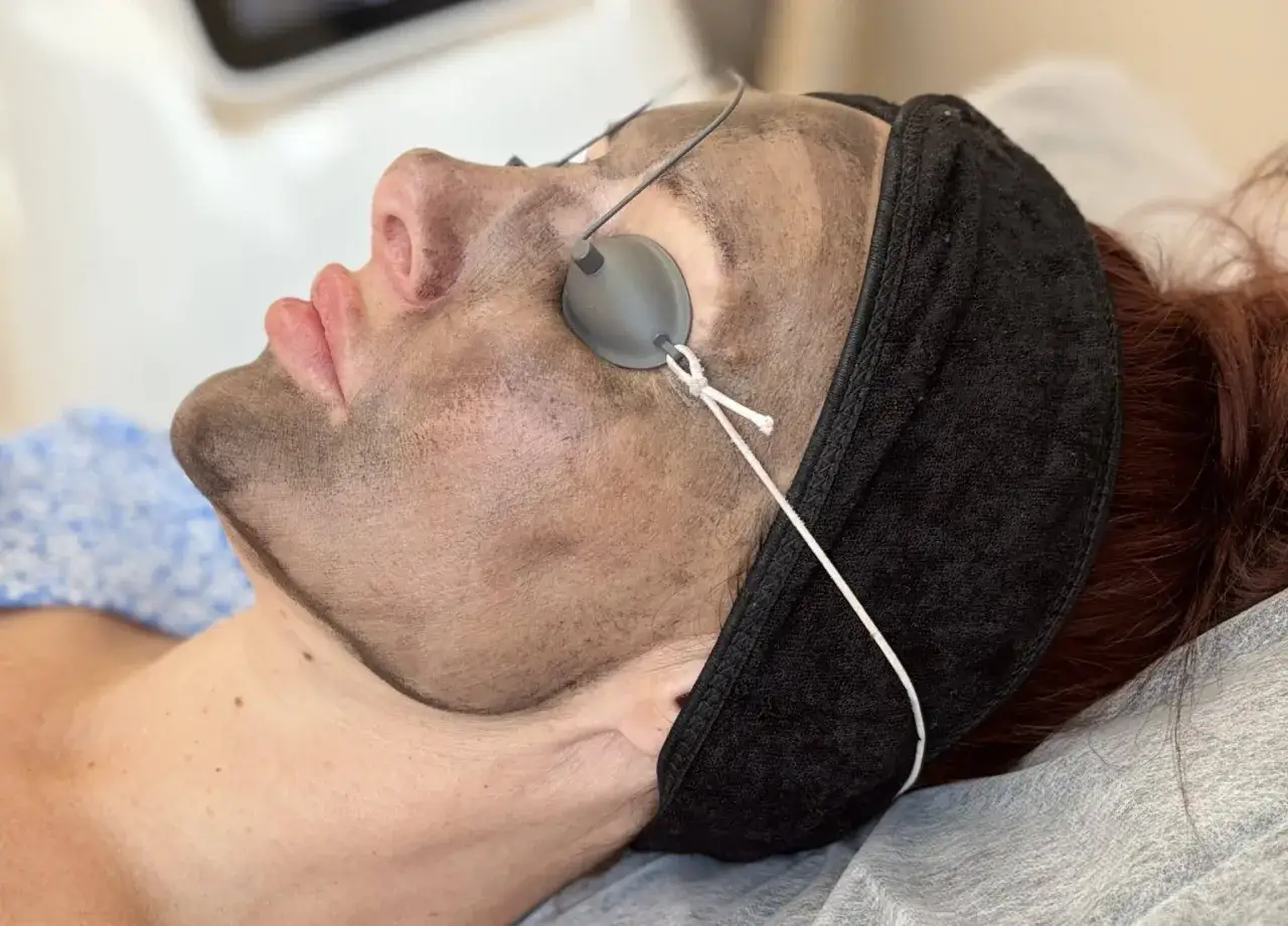 Ansiktsbehandling med kolmask och skyddsglasögon. Lasern kan hjälpa till att minska synligheten av stora porer.