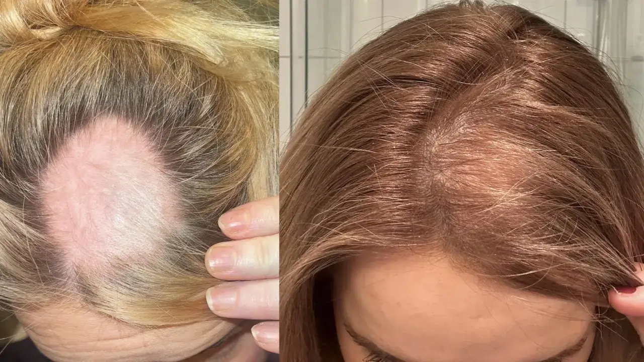 Före- och efterbild på en kvinna med alopecia areata. Vänstra sidan visar en kal fläck i det blonda håret, högra sidan visar tätare, brunaktigt hår.