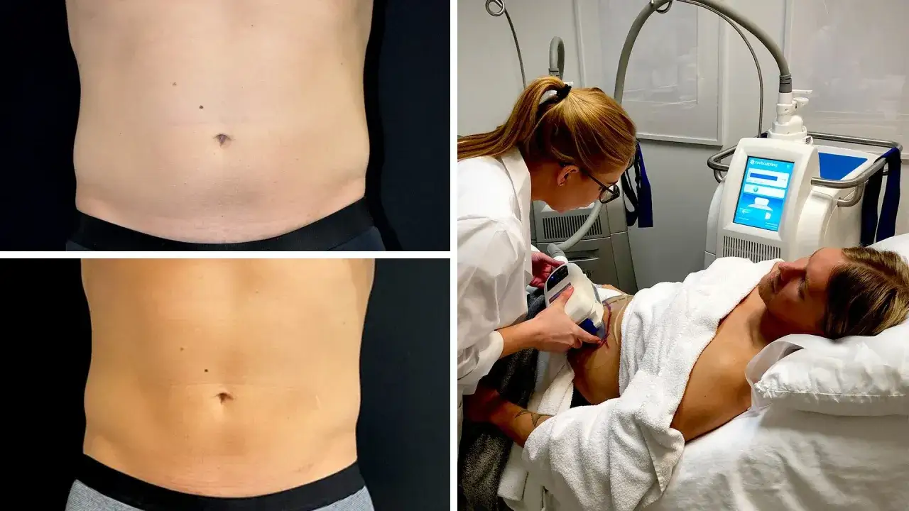 Före- och efterbilder på en mage som behandlats med coolsculpting. En kvinna utför behandlingen på en liggande man.
