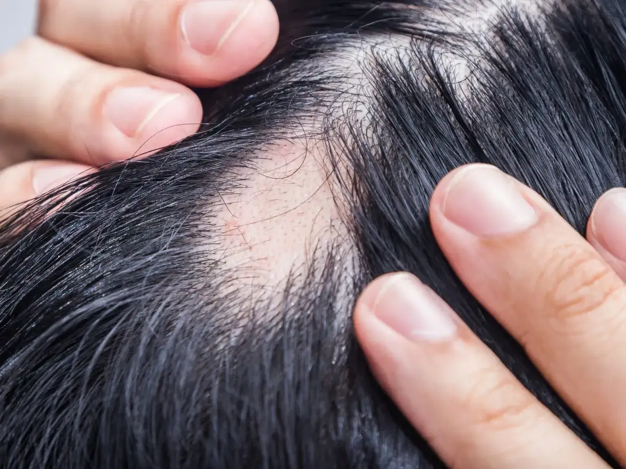Händer som undersöker en fläck med håravfall på huvudet, en synlig del av alopecia areata behandling.