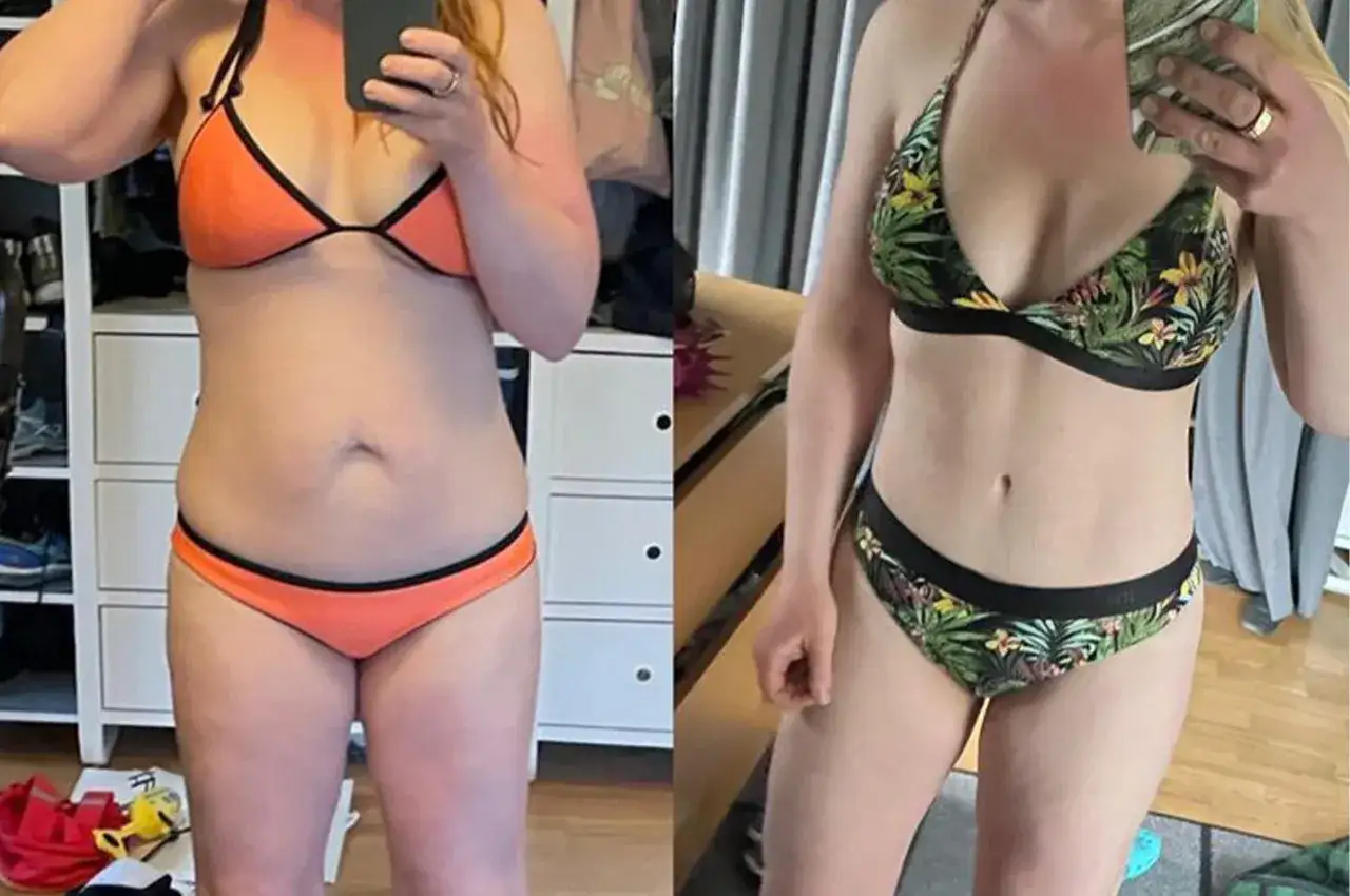 Före och efter bilder visar en kvinnas mage. Till vänster, före en full bukplastik, med en mjukare mage. Till höger, efter, med en fastare och plattare mage.