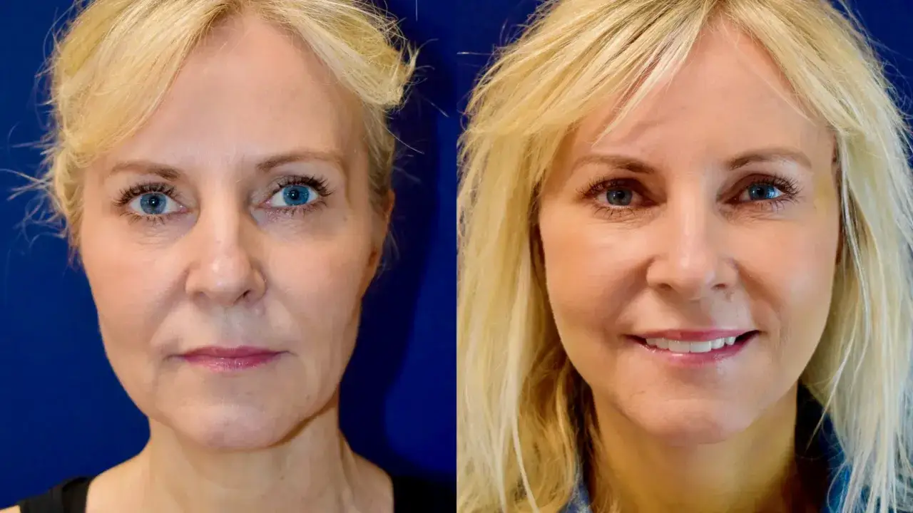 Före- och efterbilder visar en kvinna som genomgått buccal fat removal i Sverige, med mjukare ansiktskonturer och en mer definierad käklinje.