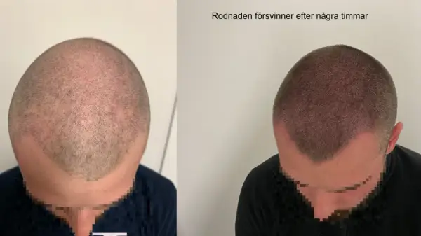 Före och efter bild på en hårtransplantation. Rodnaden i hårbotten, som kan uppstå efter att man vill exfoliera hårbotten, försvinner efter några timmar.